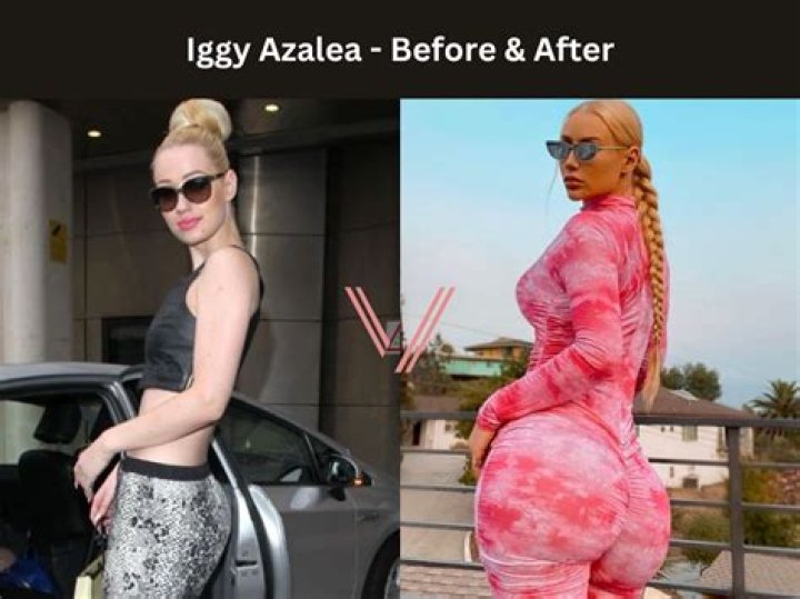 Jen_ny69 Before And After Surgery BBL: Everything To Know About The YouTuber